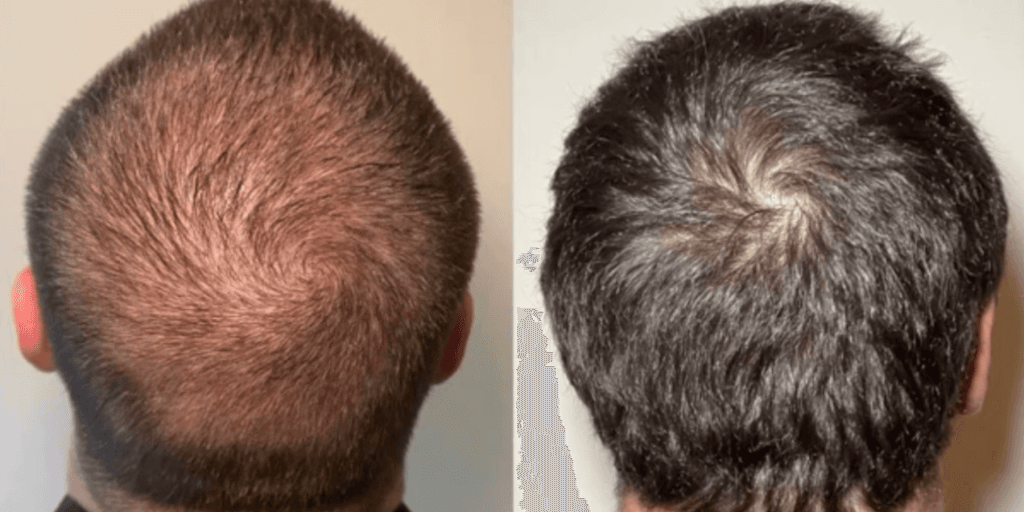 Hair restoration before and after - patient 1