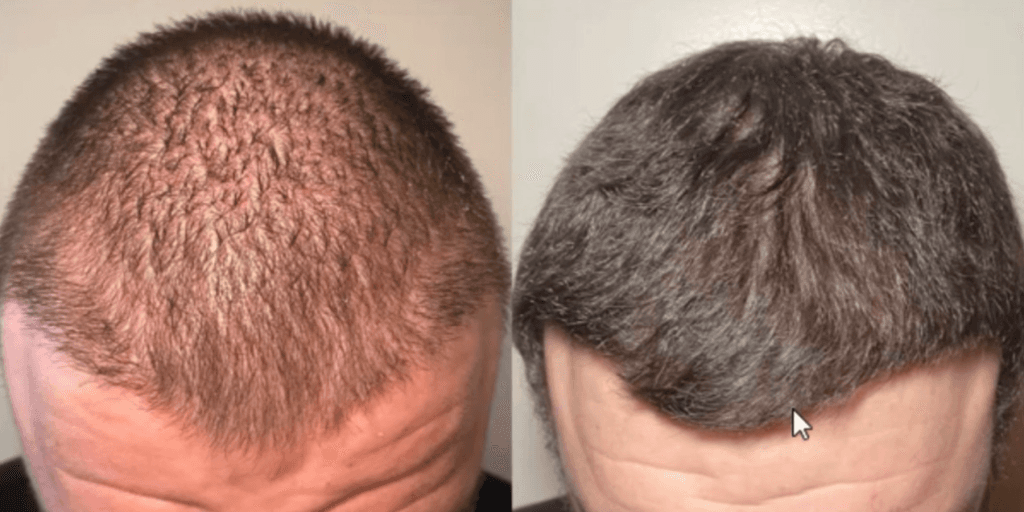 Hair restoration before and after - patient 2