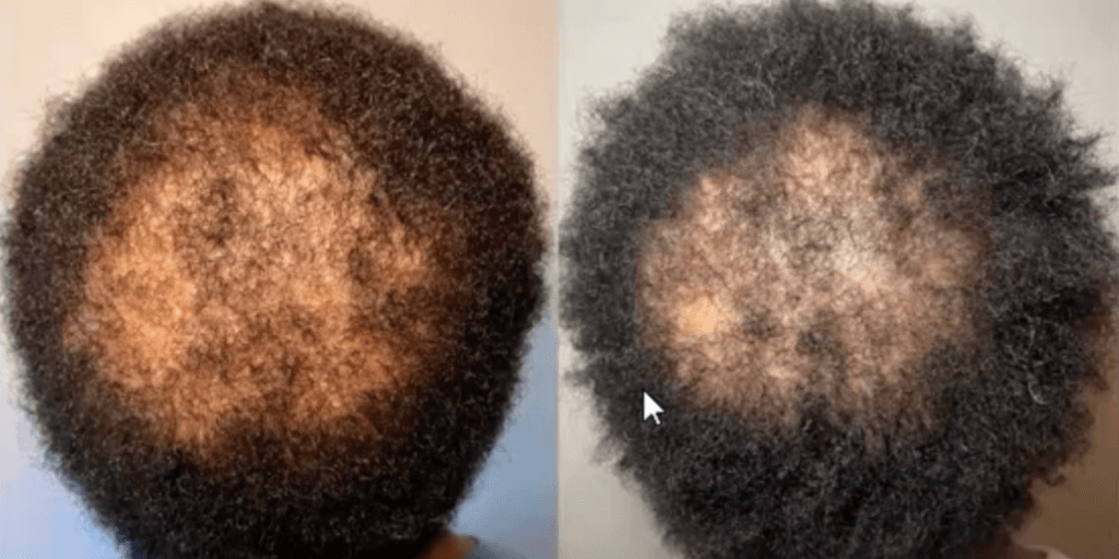 Hair restoration before and after - patient 3