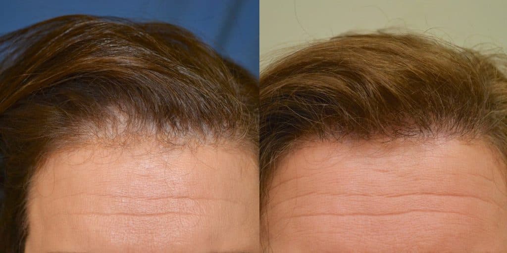 Hair restoration before and after - female patient 1