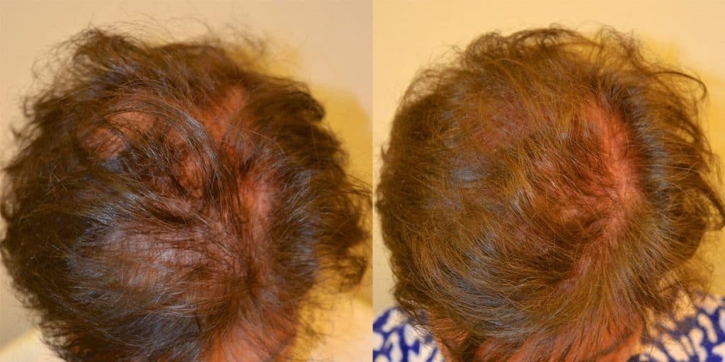 Hair restoration before and after - female patient 2