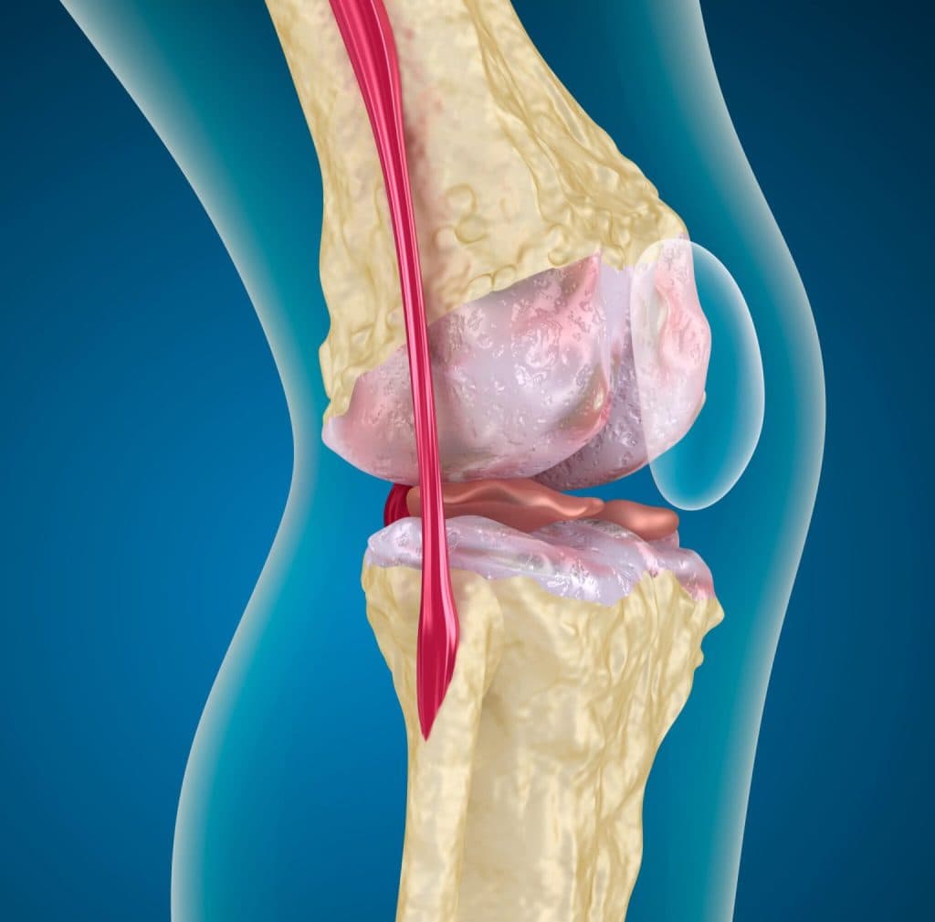 Stem cell therapy for knee osteoarthritis